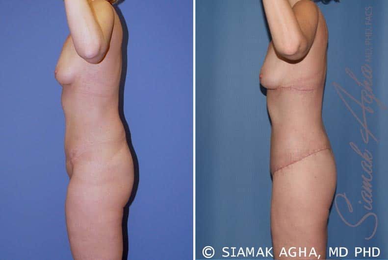 Total Body Lift Before & After