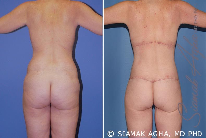 Total Body Lift Before & After