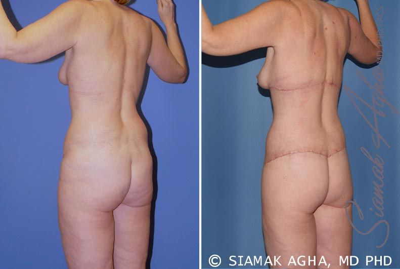 Total Body Lift Before & After