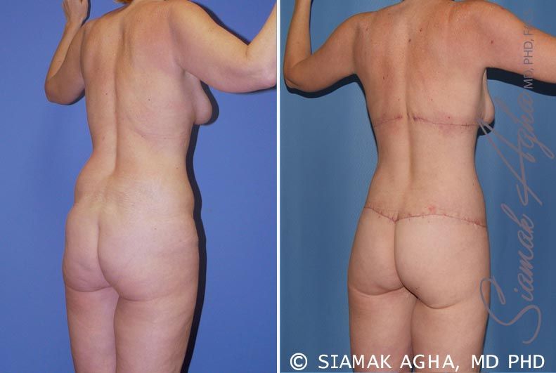 Total Body Lift Before & After