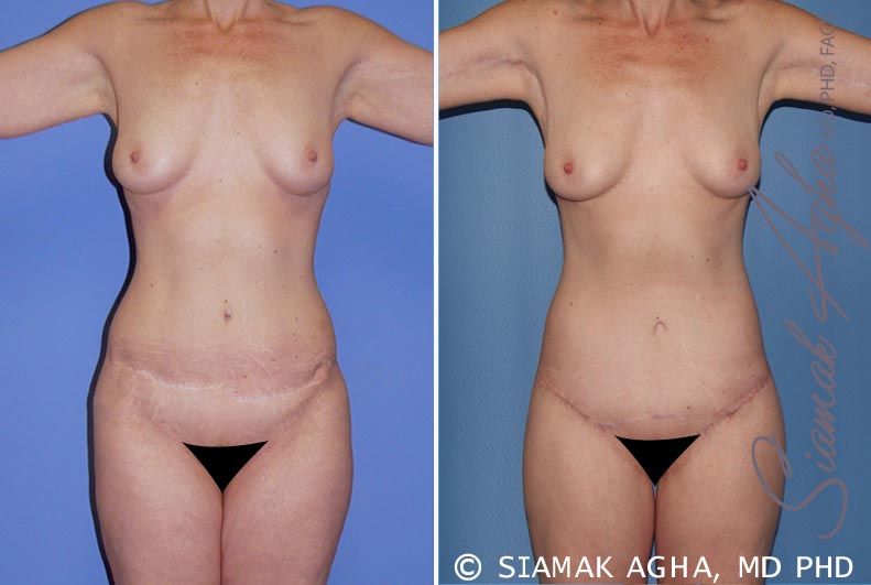 Total Body Lift Before & After