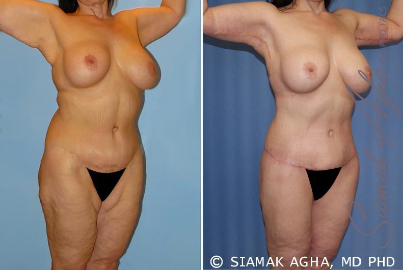 Total Body Lift Before & After