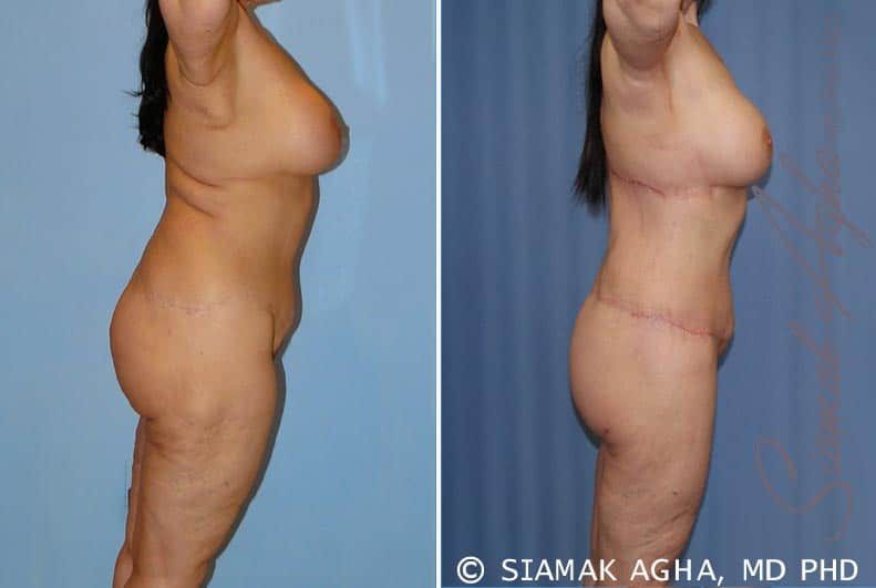 Total Body Lift Before & After