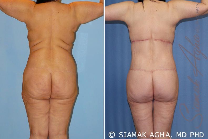 Total Body Lift Before & After