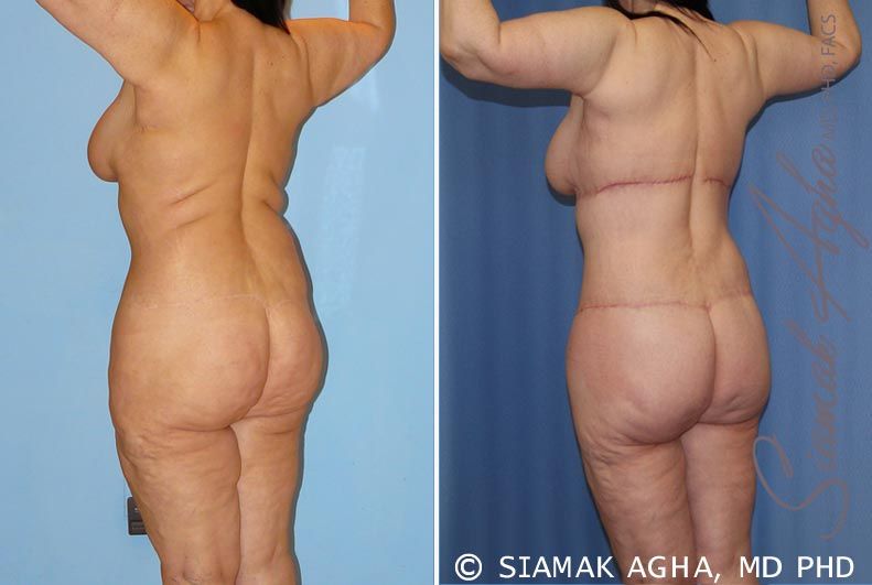 Total Body Lift Before & After