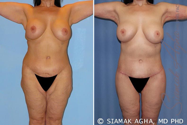 Total Body Lift Before & After