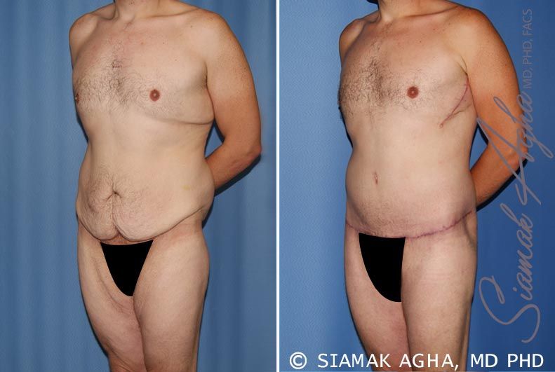 Total Body Lift Before & After