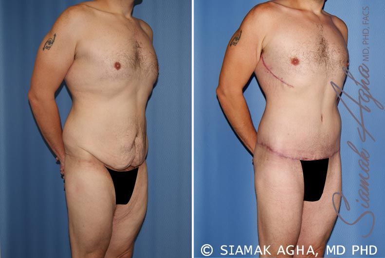 Total Body Lift Before & After