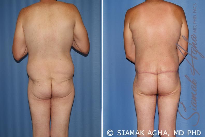 Total Body Lift Before & After