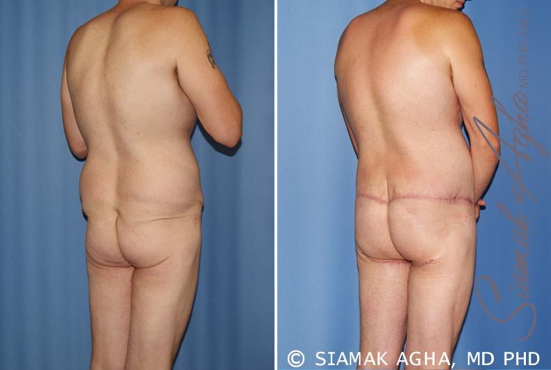 Total Body Lift Before & After