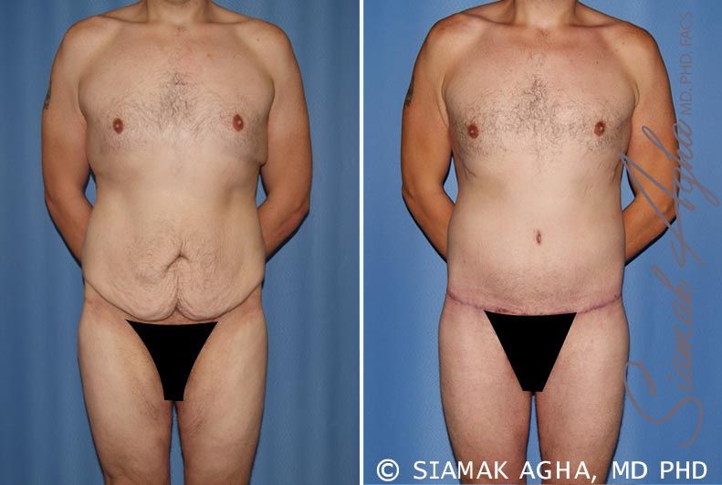 Total Body Lift Before & After