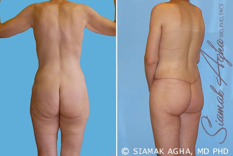 Total Body Lift Before & After