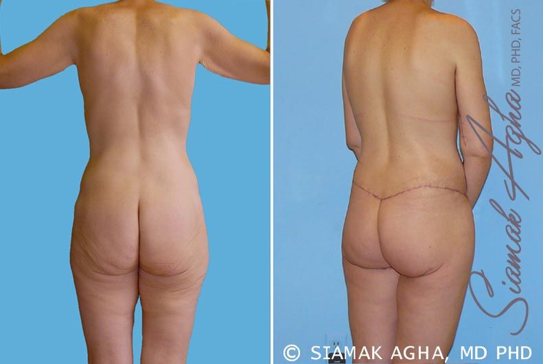 Total Body Lift Before & After