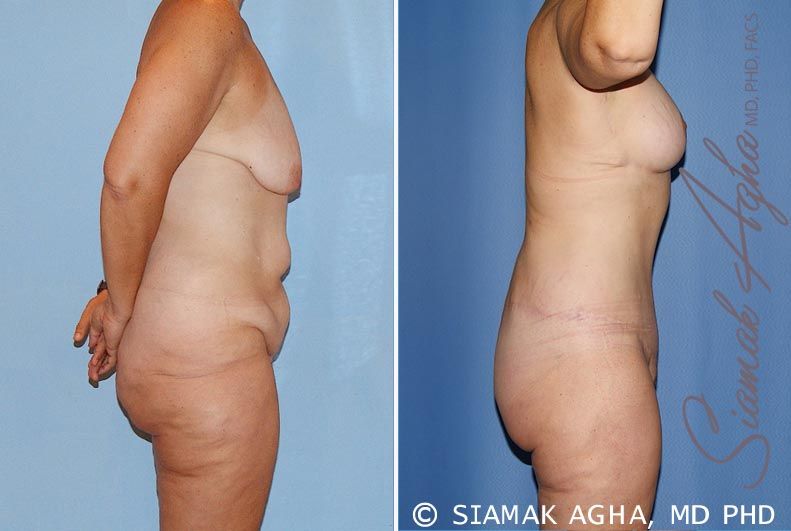 Total Body Lift Before & After