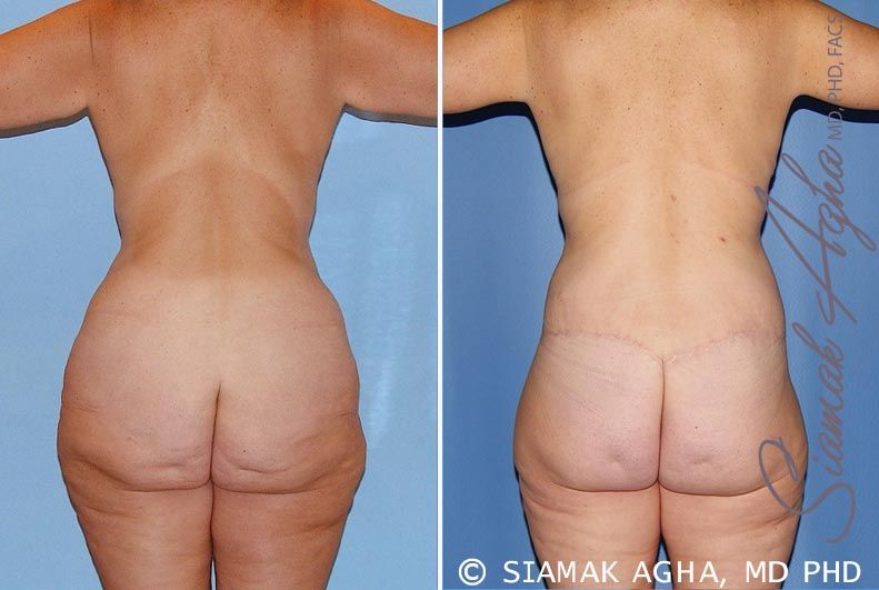 Total Body Lift Before & After