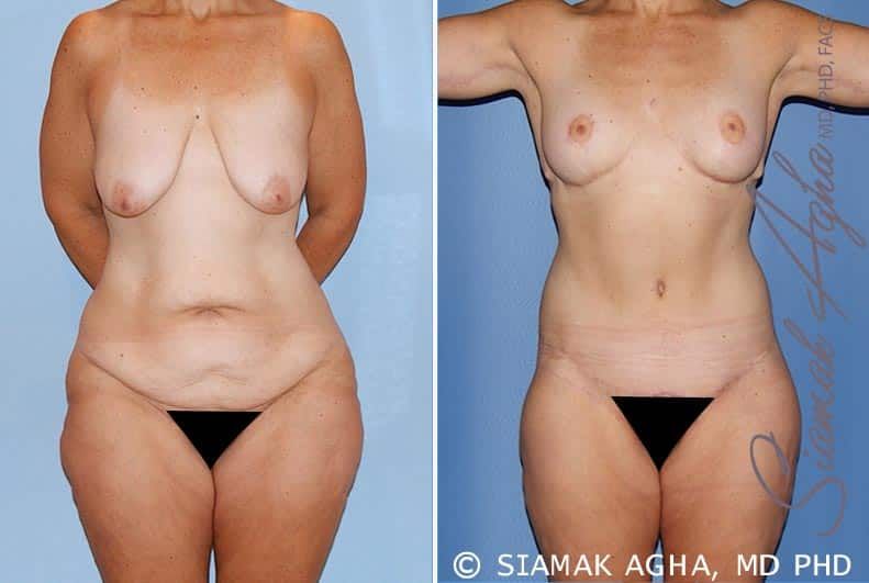 Total Body Lift Before & After