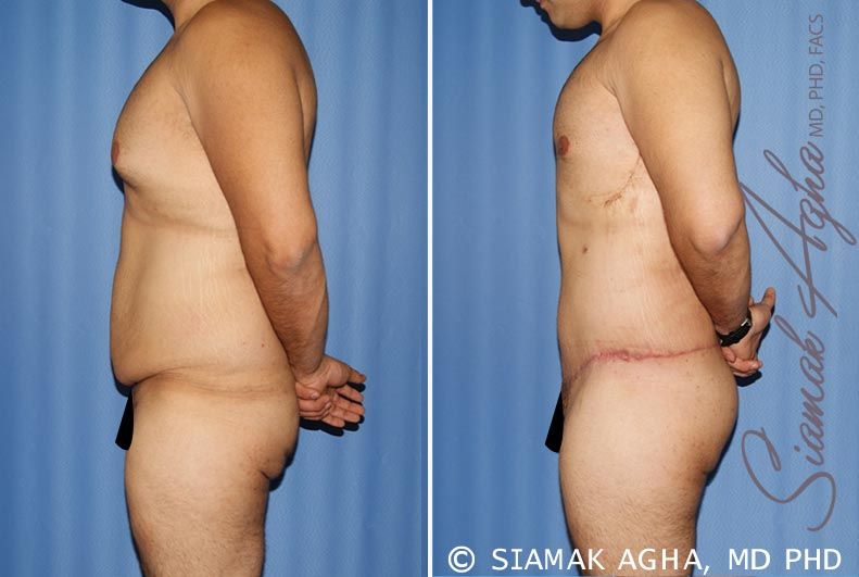 Total Body Lift Before & After