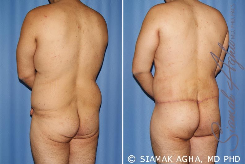 Total Body Lift Before & After