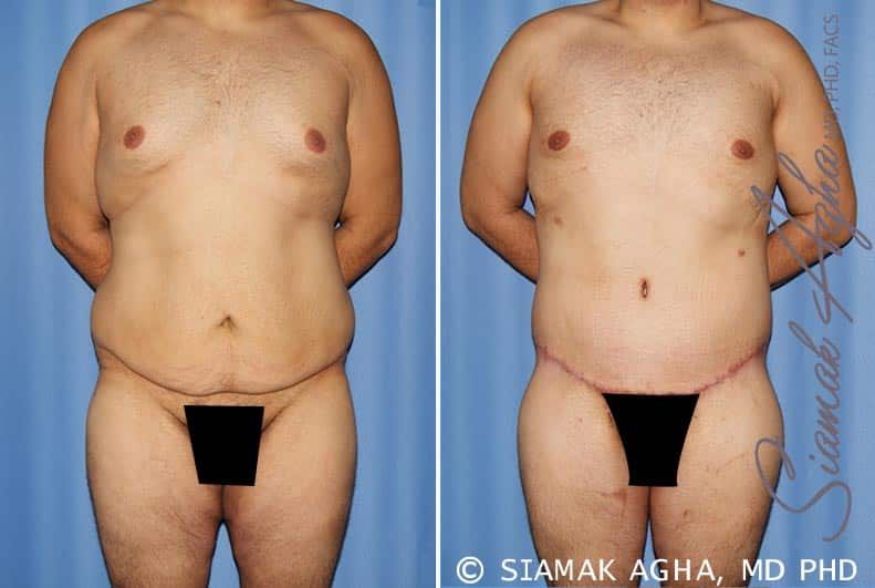 Total Body Lift Before & After