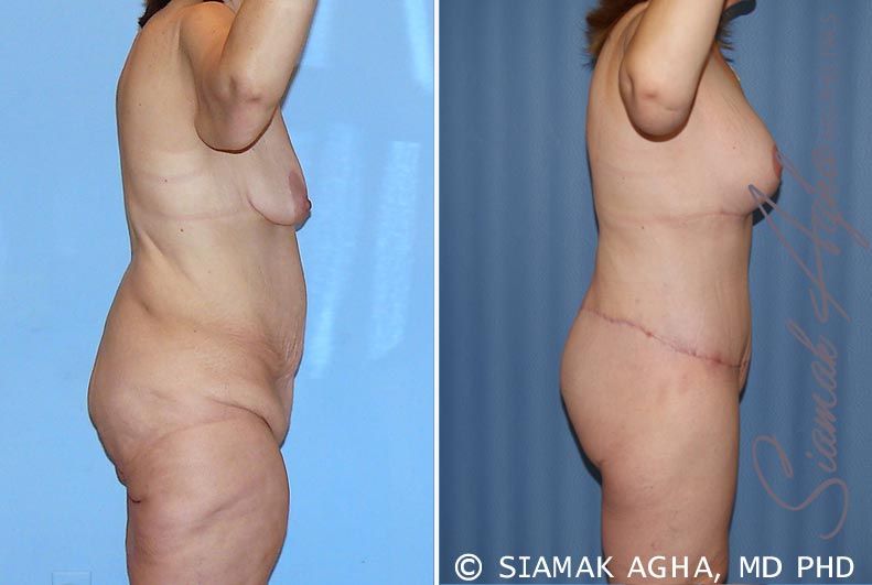 Total Body Lift Before & After