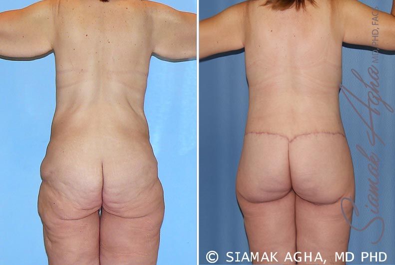 Total Body Lift Before & After