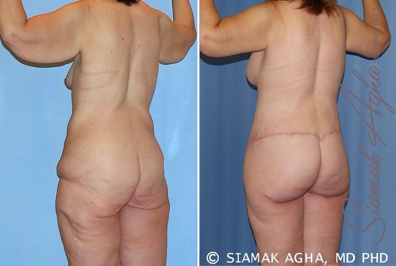Total Body Lift Before & After