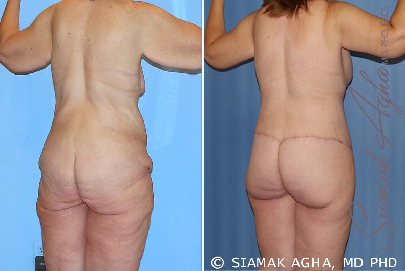 Total Body Lift Before & After