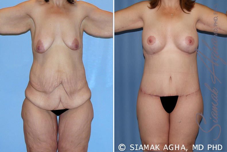 Total Body Lift Before & After