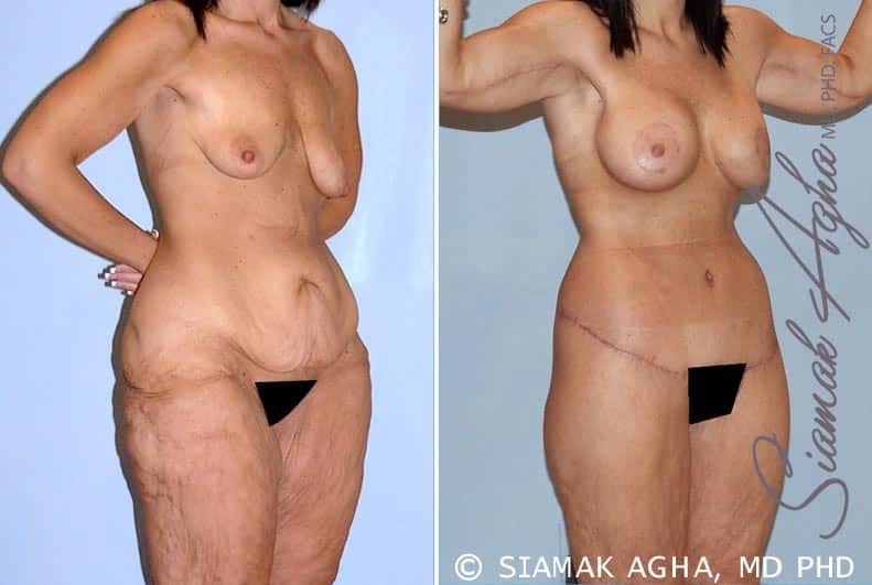 Total Body Lift Before & After
