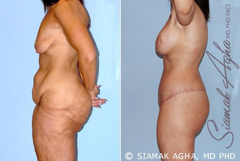 Total Body Lift Before & After