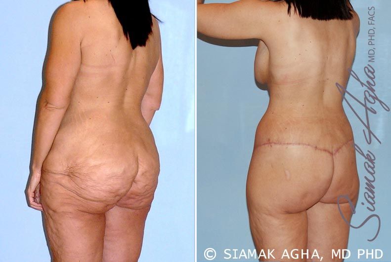 Total Body Lift Before & After
