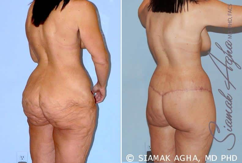 Total Body Lift Before & After