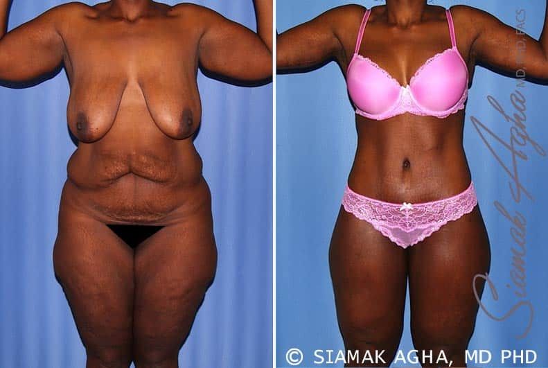 Total Body Lift Before & After