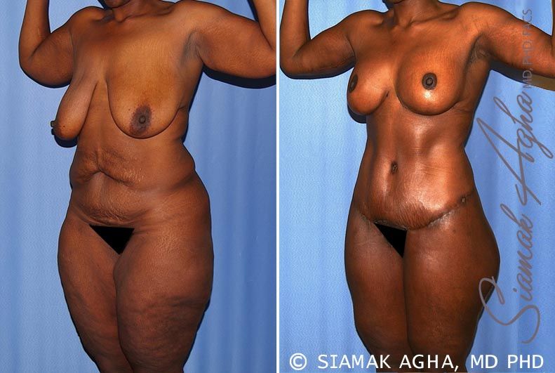 Total Body Lift Before & After