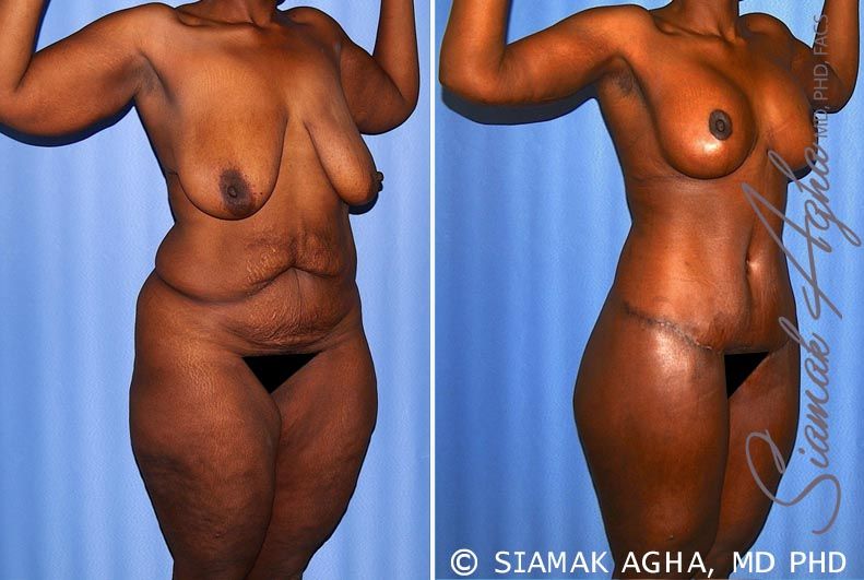 Total Body Lift Before & After