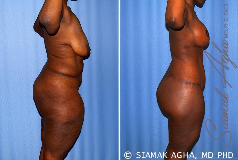 Total Body Lift Before & After