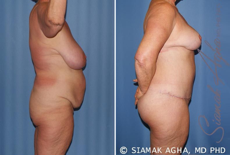 Total Body Lift Before & After