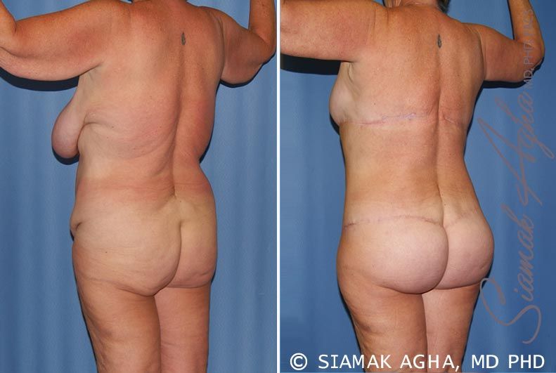 Total Body Lift Before & After