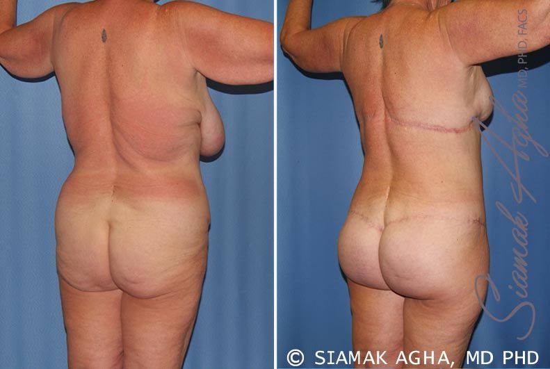 Total Body Lift Before & After