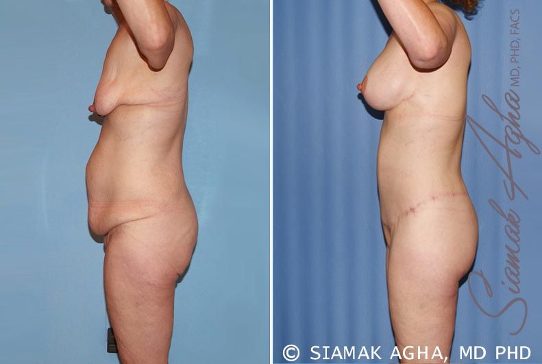 Total Body Lift Before & After