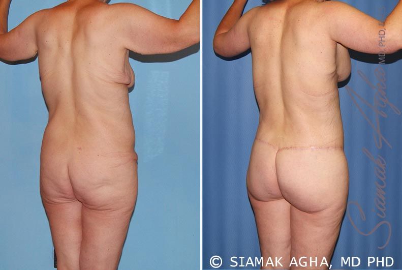 Total Body Lift Before & After