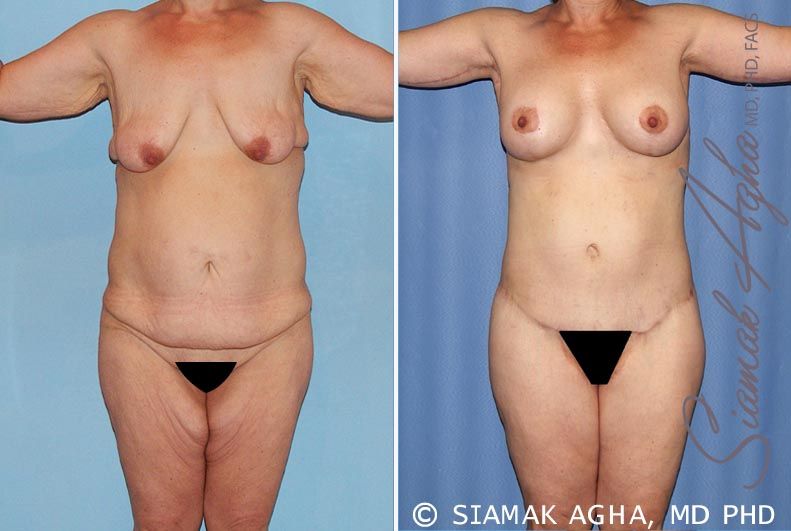 Total Body Lift Before & After