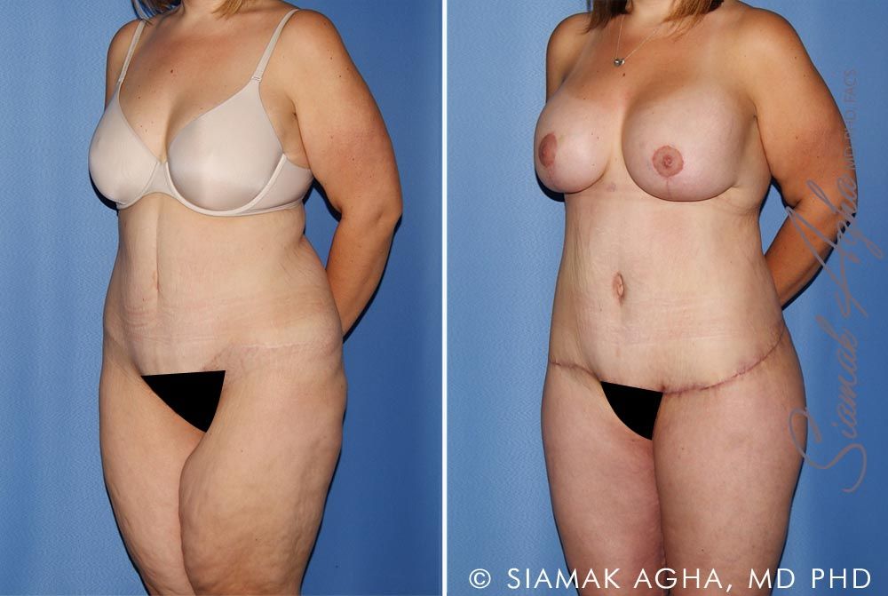 Total Body Lift Before & After