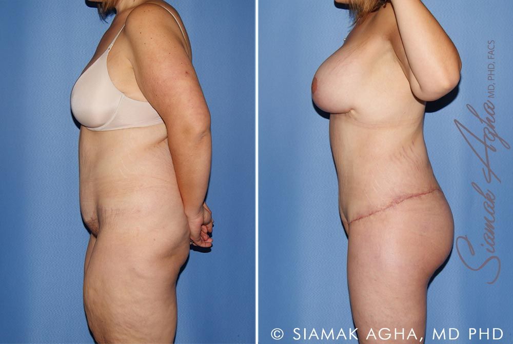 Total Body Lift Before & After