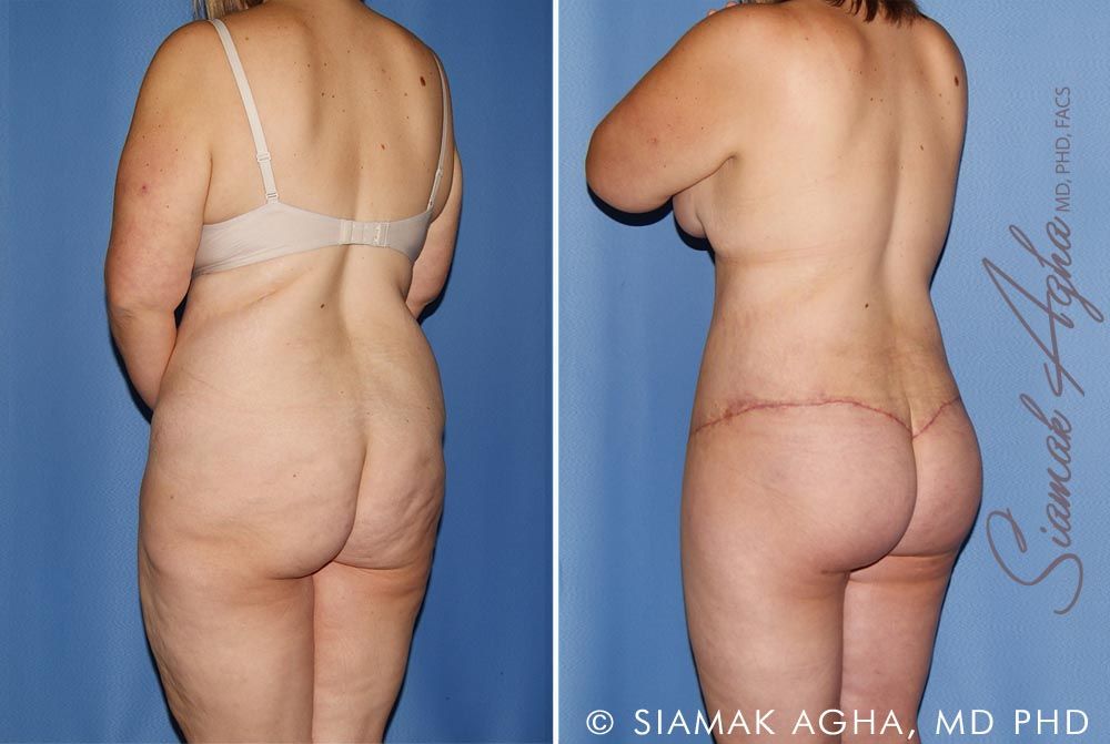 Total Body Lift Before & After