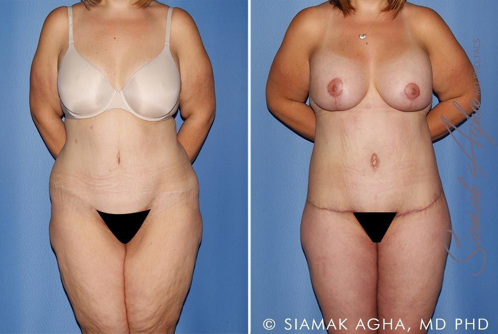 Total Body Lift Before & After