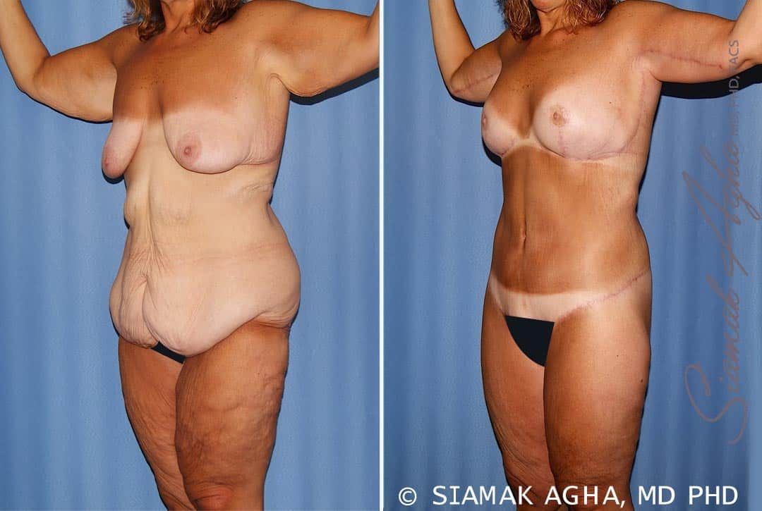 Total Body Lift Before & After