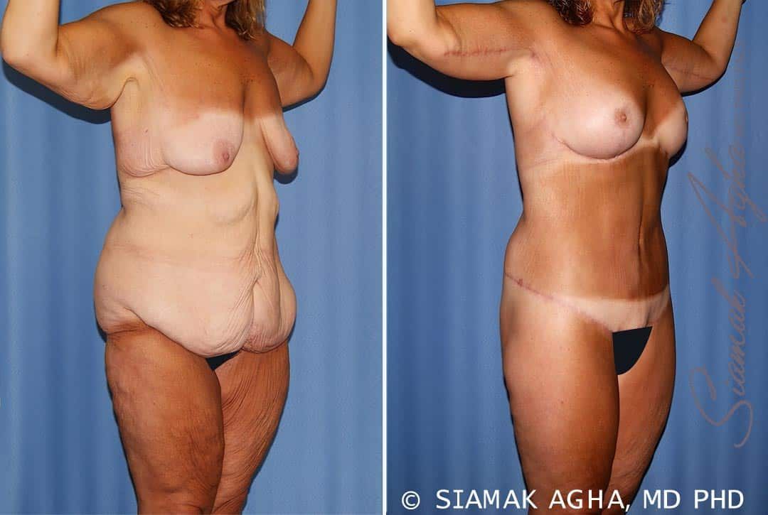 Total Body Lift Before & After