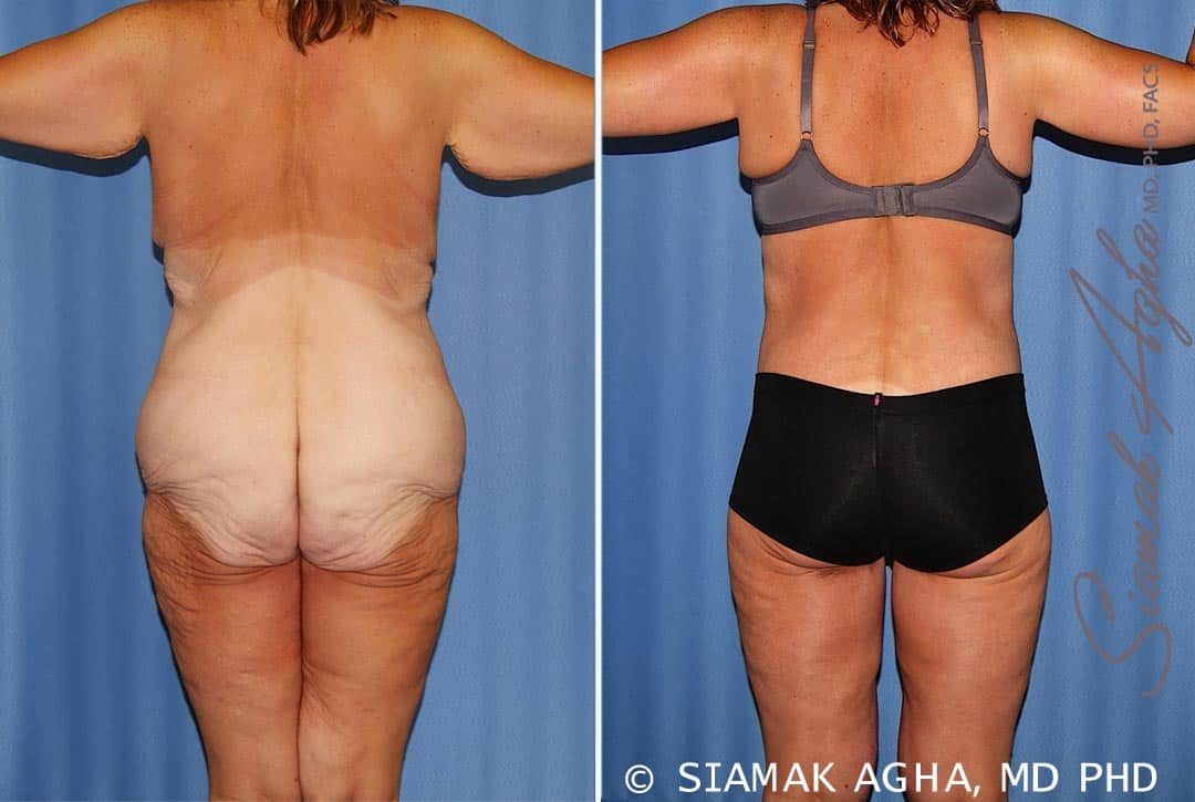 Total Body Lift Before & After