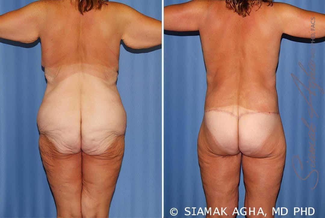 Total Body Lift Before & After